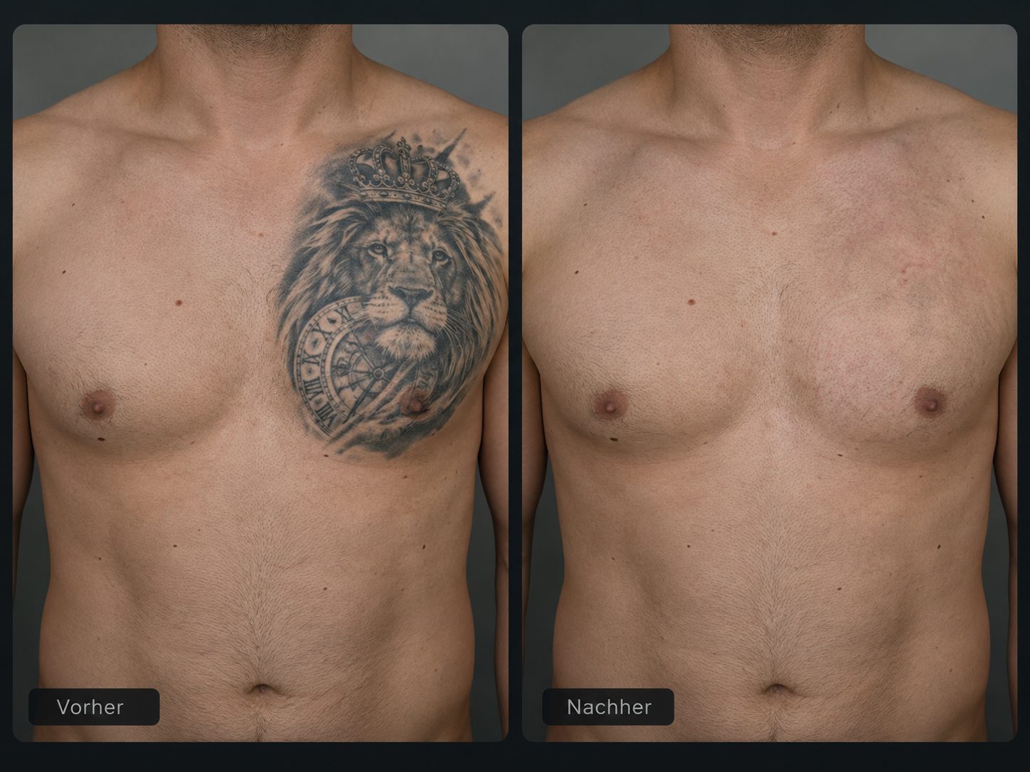 Männerbrust mit Löwen-Tattoo im direkten Vergleich vorher und nachher